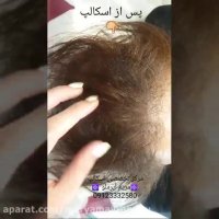 اسکالپ سر برای رفع کم پشتی مو ها در خانم ها