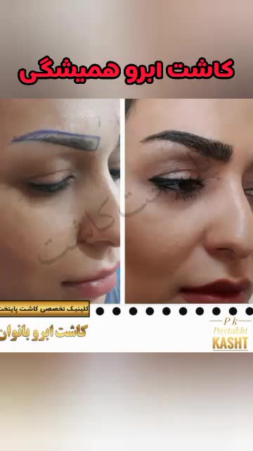 کاشت ابرو طبیعی | کلینیک پایتخت | 44228594-021
