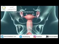 هیسترکتومی