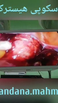 عمل جراحی لاپاراسکوپی هیسترکتومی به جای جراحی باز