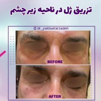 رفع گودی زیر چشم با تزریق ژل