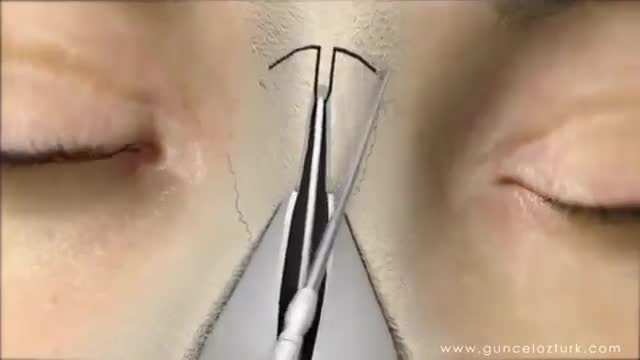 فیلم جراحی زیبایی بینی