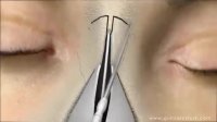 فیلم جراحی زیبایی بینی