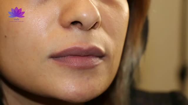 تزریق ژل لب در کلینیک ارکیده
