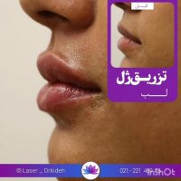 تزریق ژل لب در کلینیک ارکیده