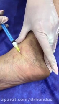 درمان واریس پا با اسکلروتراپی