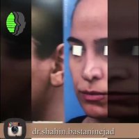 جراحی ترمیمی بینی زینی شکل