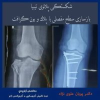 فیلم شکستگی پلاتوی تیبیا