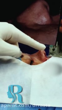 صفر تا صد جراحی بینی در اتاق عمل