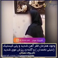 وجود همزمان فقر آهن شدید و تنبلی تخمدان و آکنه وریزش موی شدید