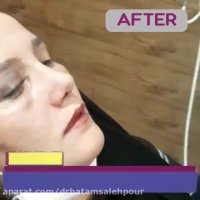 نمونه جراحی زیبایی بینی