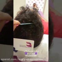 رفع کامل کم پشتی موها با انجام اسکالپ