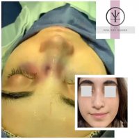 فیلم جراحی بینی گوشتی