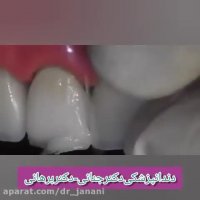 ترمیم و بازسازی واصلاح بد رنگی دندان سانترال