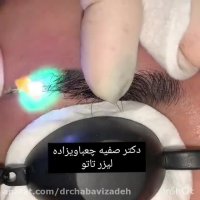 پاک کردن خالکوبی با لیزر