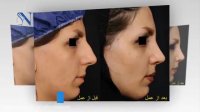 فیلم جراحی زیبایی بینی