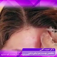 فیلم تزریق بوتاکس