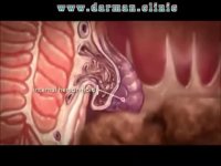 بواسیر یا هموروئید چیست؟ - درمان کلینیک