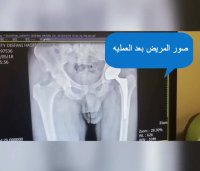 فحص المریض بعد 6 اشهر من عملیه استبدال المفصل