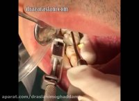 فیلم قبل از روکش کردن دندان دست نگه دارید و این ویدئو را ببینید