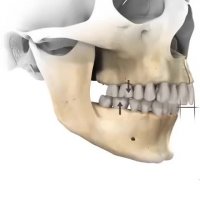 خلاصه ای از انجام اعمال مختلف جراحی فک به صورت انیمیشن