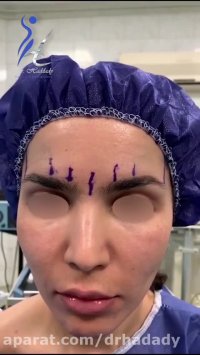 لیفت اندوسکوپیک پیشانی و فیکساسیون