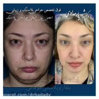 لیفت اندوسکوپی پیشانی و بلفاروپلاستی فوقانی