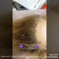 اسکالپ تخصصی روشی نوین برای رفع کم پشتی موهای سر