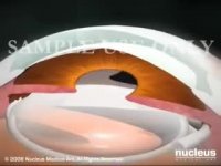 Cataract Surgery (2009)