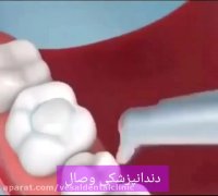 فیلم پر کردن دندان