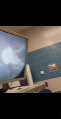 فیلم خارج کردن سنگ مثانه