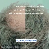 بهترین روش کاشت مو