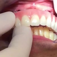 دست دندان بر پایه ایمپلنت-مرکز فوق تخصصی ایمپلنت پردیس www.pardisdental.ir