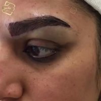 کاشت ابرو طبیعی کلینیک رنسانس