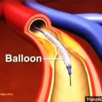 فیلم بالن قلب