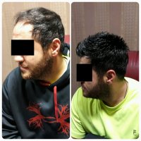 ترمیم موی الگانت02188962259