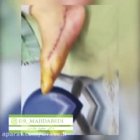 جراحی پا چنبری