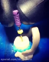 درمان ریشه دندان