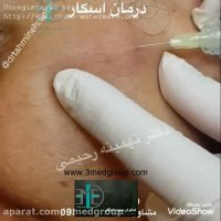 کربوکسی تراپی فن آوران سپید جامگان