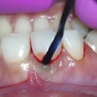 اصلاح طرح لبخند