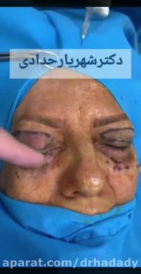 جراحی پلک در خانم 67 ساله