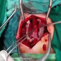 جراحی تنگی شدید کانال کمری و اسکولیوز دژنراتیو