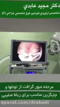 قفل شدن زانو به علت پارگی رباط صلیبی و پارگی منیسک داخلی