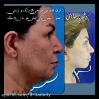 فیلم لیفت صورت و گردن