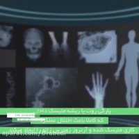 پارگی منیسک