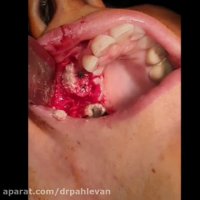 ایمپلنت دندان