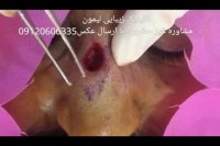 اصلاح جای تومور و زخم روی بینی