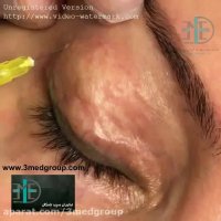 کربوکسی تراپی فناوران سپید جامگان