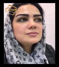 فیلم کاشت ابرو