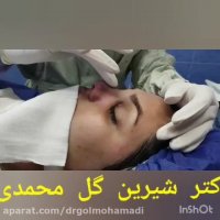 جراحی بینی بلافاصله بعد از عمل
